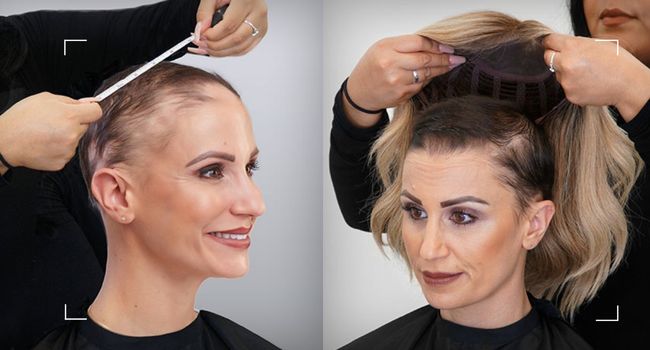Hair loss due to chemotherapy?